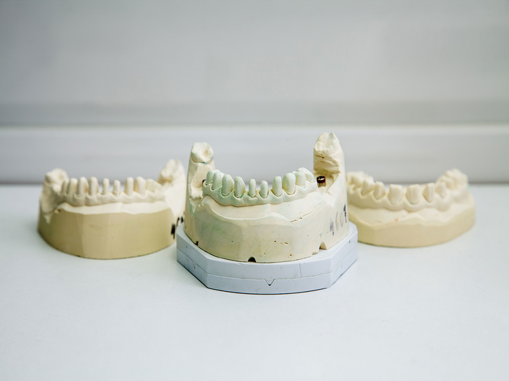 Имплантация зубов: есть ли риски и противопоказания после 60 лет